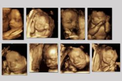 4D-Sonographie